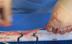video : chirurgie du genou
