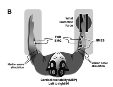 La stimulation électrique neuromusculaire haute fréquence module l’inhibition inter hémisphérique chez des sujets sains