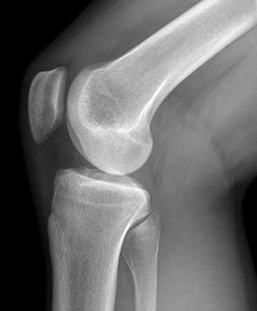 Efficacité du biofeedback en temps réel sur l’adduction du genou dans l’arthrose médiale de genou
