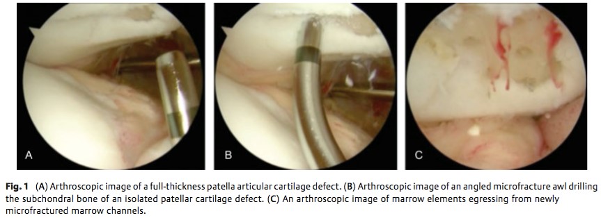 Restauration cartilagineuse : micro fracture et transplantation ostéochondrale en auto greffe