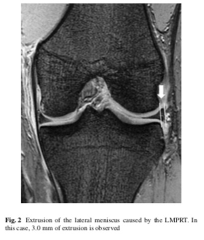 Instabilité rotatoire antérolatérale et extrusions méniscales lors des lésions du ligament croisé antérieur : rôle des lésions de la corne postérieure du ménisque latéral