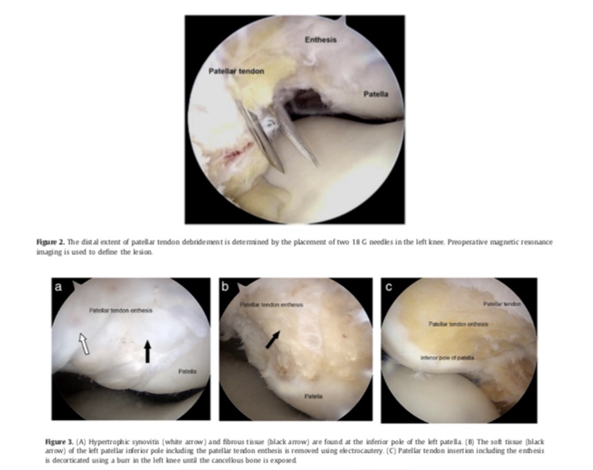Tendinopathie patellaires réfractaires traitées par résection arthroscopique du pôle patellaire inférieur chez des sportifs professionnels