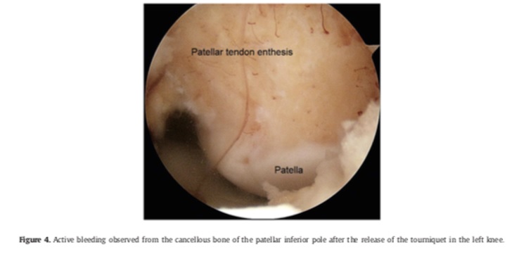 Tendinopathie patellaires réfractaires traitées par résection arthroscopique du pôle patellaire inférieur chez des sportifs professionnels