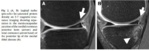 Diagnostic par imagerie par résonance magnétique des ramp lésions du ménisque médiale chez les patients présentant des lésions du ligament croisé antérieur