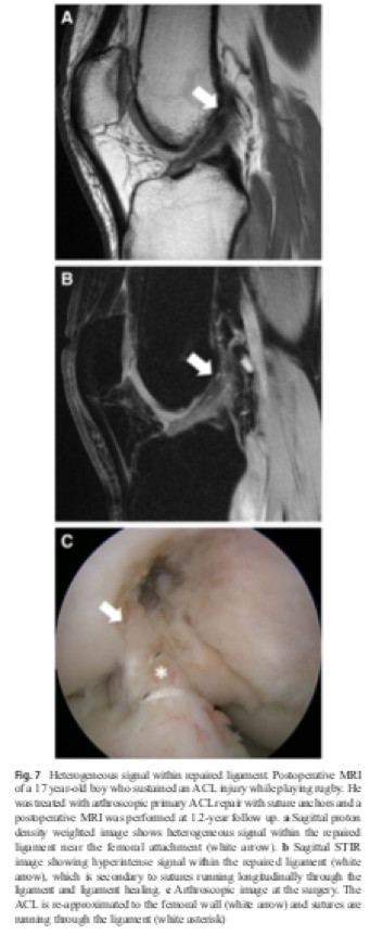 Quelles sont les caractéristiques préopératoires d’imagerie permettant l’éligibilité à la réparation ligamentaire dans le cas d’une rupture de LCA ? Techniques chirurgicales et imageries postopératoires.
