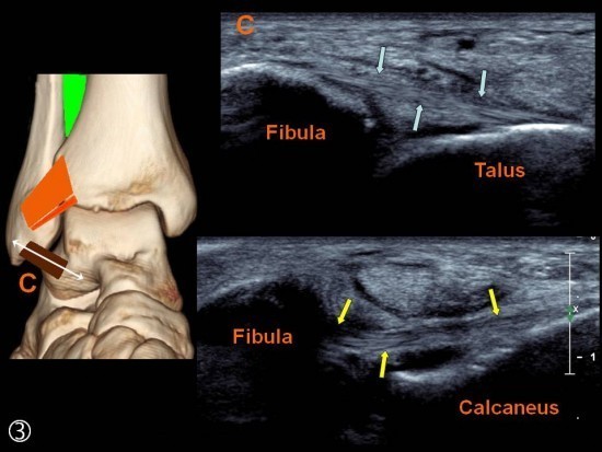 Ligament Tibio Fibulaire Antéro Distal (LTFAI)
