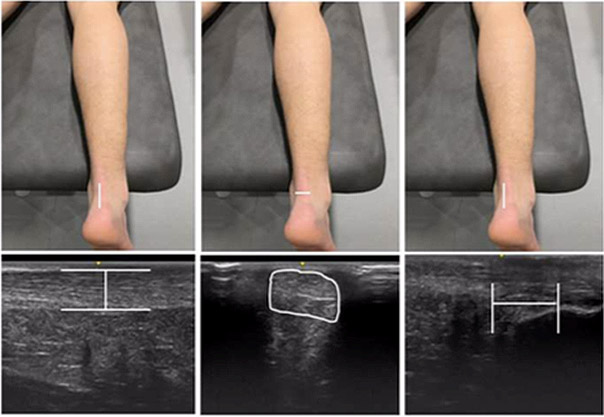 Comparaison des résultats échographiques du tendon d’Achille chez les patients présentant ou non des tendinopathies.
