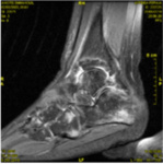 Mise à jour sur le diagnostic et la gestion des fractures du cuboïde