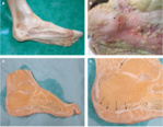 Anatomie du fascia plantaire et relation avec le tendon et le paratenon achiléen.