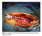 Chirurgie versus traitement conservateur dans le cadre d'une hernie discale lombaire