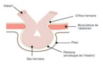 Résultats à long terme de la réparation ouverte des hernies inguinales récidivantes  par maille prépéritonéale