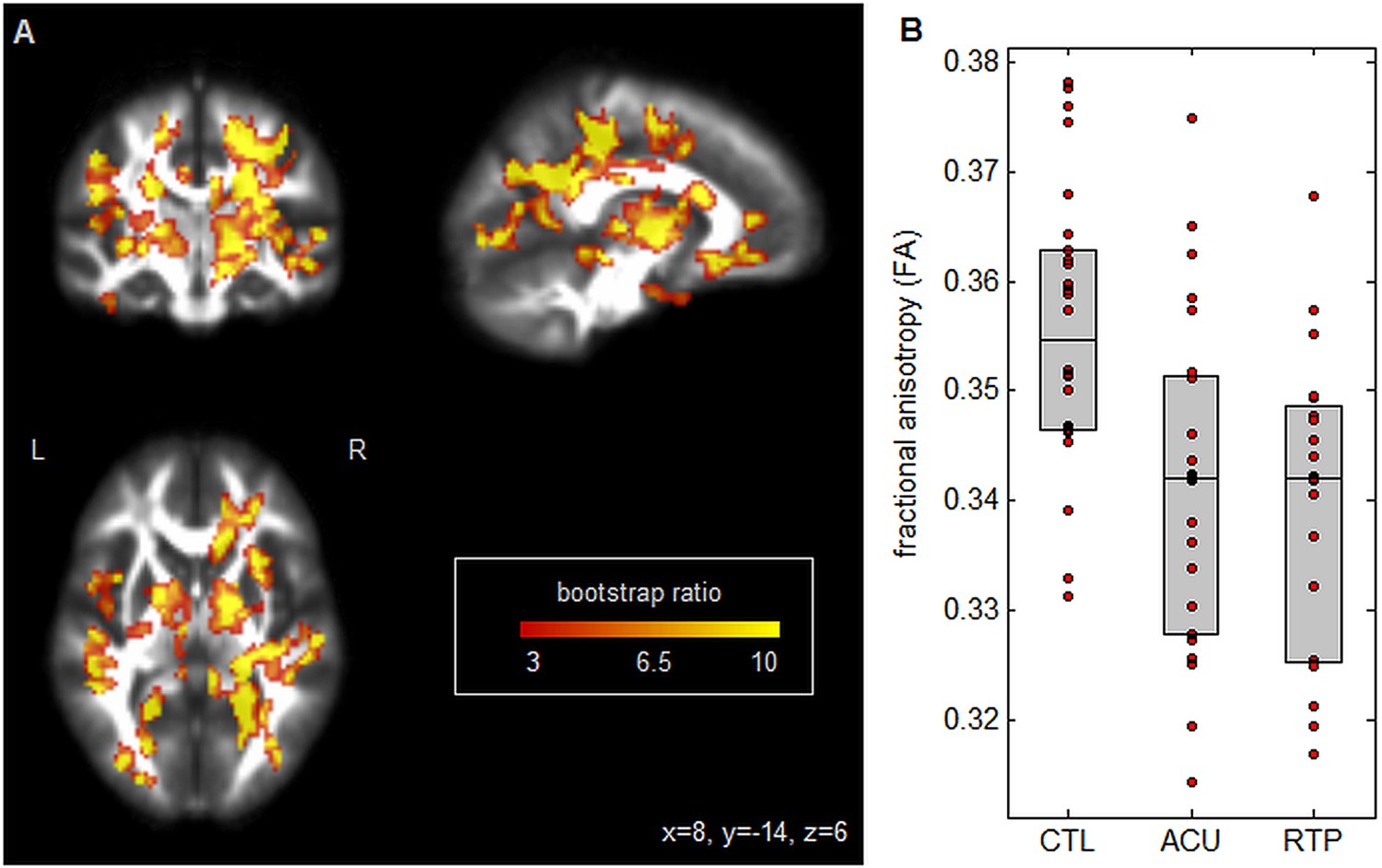 Neuro-imagerie de la commotion cérébrale : altération persistante de la structure et de la fonction du cerveau lors de l’autorisation de reprise sportive