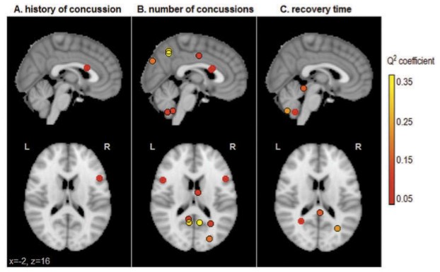 Changements dans la connectivité fonctionnelle du cerveau associés à un historique de commotion cérébrale : une enquête préliminaire