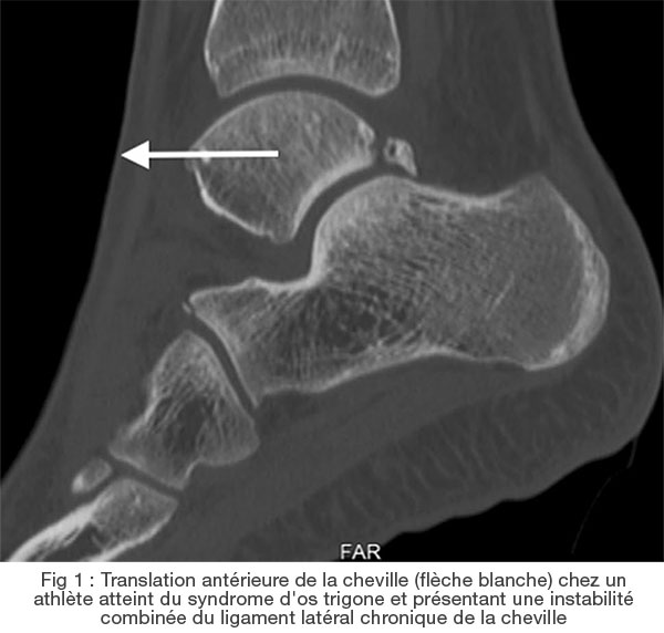 L'instabilité latérale chronique de la cheville augmente le risque de chirurgie chez les athlètes atteints du syndrome de l'os trigone