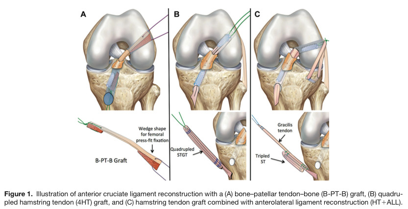 - llustration of anterior cruciate ligament reconstruction with a (A) bone-patellar tendon-bone (B-PT-B) graft, (B) quadrupled hamstring tendon (4HT) graft, and (C) hamstring tendon graft combined with anterolateral ligament reconstruction (HT+ALL).