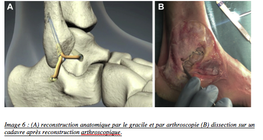Reconstruction anatomique du Ligament Latéral de la cheville avec une autogreffe du gracile par arthroscopie.
