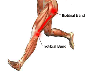 Évaluation de la force, de la souplesse et de la mécanique de la course chez des hommes avec syndrome de la bandelette ilio-tibiale