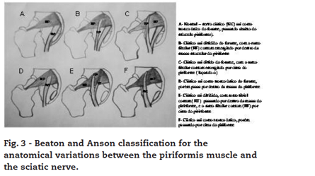 Variation anatomique du muscle piriforme et douleurs fessières profondes