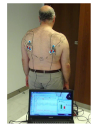 Résultats cliniques et électromyographiques du transfert du Grand dorsal pour rupture de coiffe postéro-supérieure