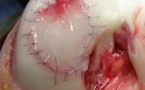 De bons résultats cliniques et IRM après une implantation de chondrocyte autologue sous arthroscopie, pour la réparation du cartilage de genou