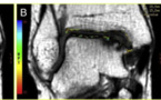 Implantation chondrocytaire autologue pour les lésions ostéochondrales du Talus : Comparaison entre les résultats d'imagerie par résonance magnétique de suivi à 5 ans et les résultats cliniques de suivi à 7 ans
