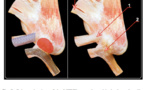 Lateral FibuloTaloCalcaneal Ligament (LFTCL) complex : une nouvelle donnée anatomique pour le compartiment externe de cheville