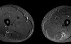L'utilisation de l'IRM pour évaluer l'activité et les lésions des muscles postérieurs de la cuisse pendant des exercices Nordic hamstring