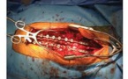 Chirurgie versus traitement conservateur dans le cadre d'une hernie discale lombaire