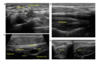 Evaluation ultrasonographique des neuropathies focales chez les athlètes : Revue clinique