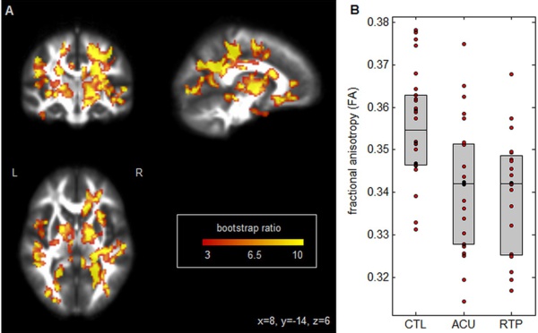 Neuro-imagerie de la commotion cérébrale : altération persistante de la structure et de la fonction du cerveau lors de l’autorisation de reprise sportive