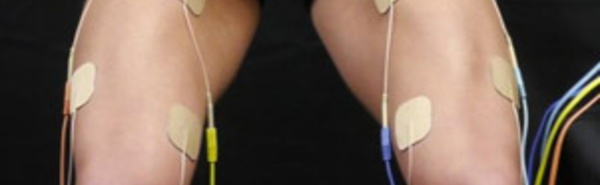 La stimulation électrique neuromusculaire est efficace pour renforcer le muscle quadriceps après une chirurgie du ligament croisé antérieur