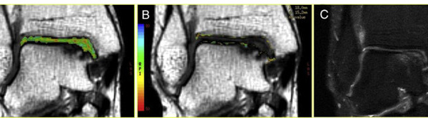 Implantation chondrocytaire autologue pour les lésions ostéochondrales du Talus : Comparaison entre les résultats d'imagerie par résonance magnétique de suivi à 5 ans et les résultats cliniques de suivi à 7 ans