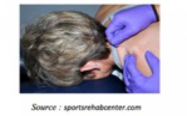 Information: Dry needling et syndrome myofascial douloureux