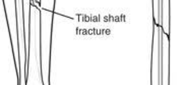 Comparaison des fractures diaphysaires du tibia au ski chez l'enfant et chez l'adulte