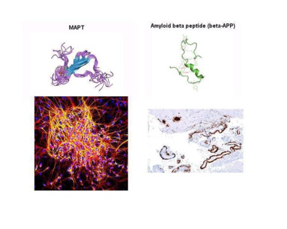 Etude: Dormir mal durablement, augmenterait le risque d'Alzheimer plus tard dans la vie