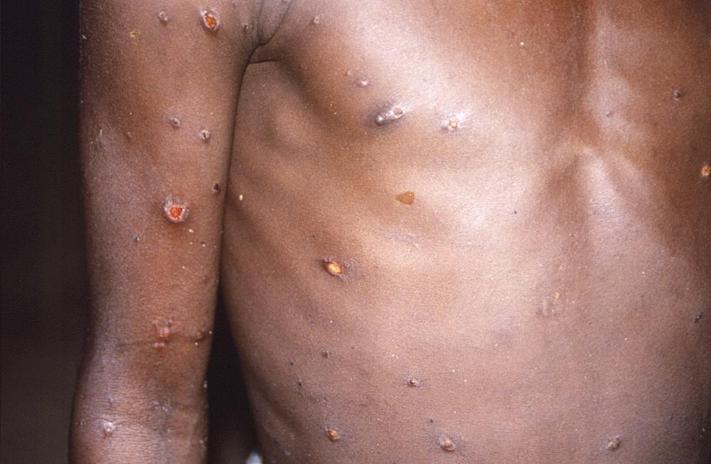 Les Africains voient une iniquité dans la réponse au monkeypox ailleurs