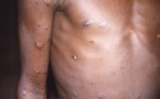 Les Africains voient une iniquité dans la réponse au monkeypox ailleurs